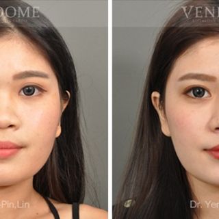 療程效果因人而異，上圖為該案例實際進行隆鼻手術術後之成效